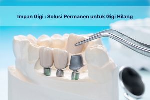 implan gigi tabanan