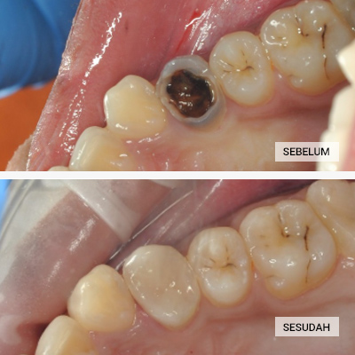 tambal gigi posterior